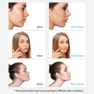 xpreen XPRE111 生物力學吸黑頭粉刺機 11 9c770620 7eb6 471b A311 Dc1547b20a41 1500x 300x300