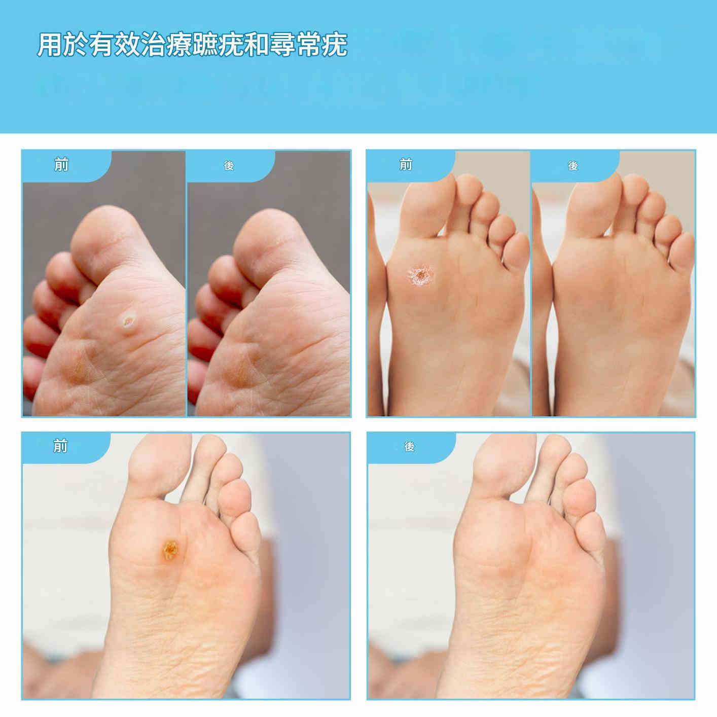 elaimei 腳部雞眼去除貼片 ( 一盒24個貼)