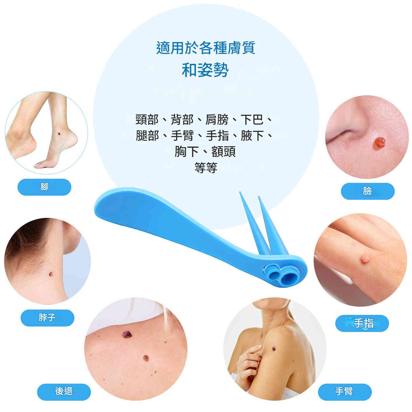 elaimei 2 合1 皮膚疣去除工具套件