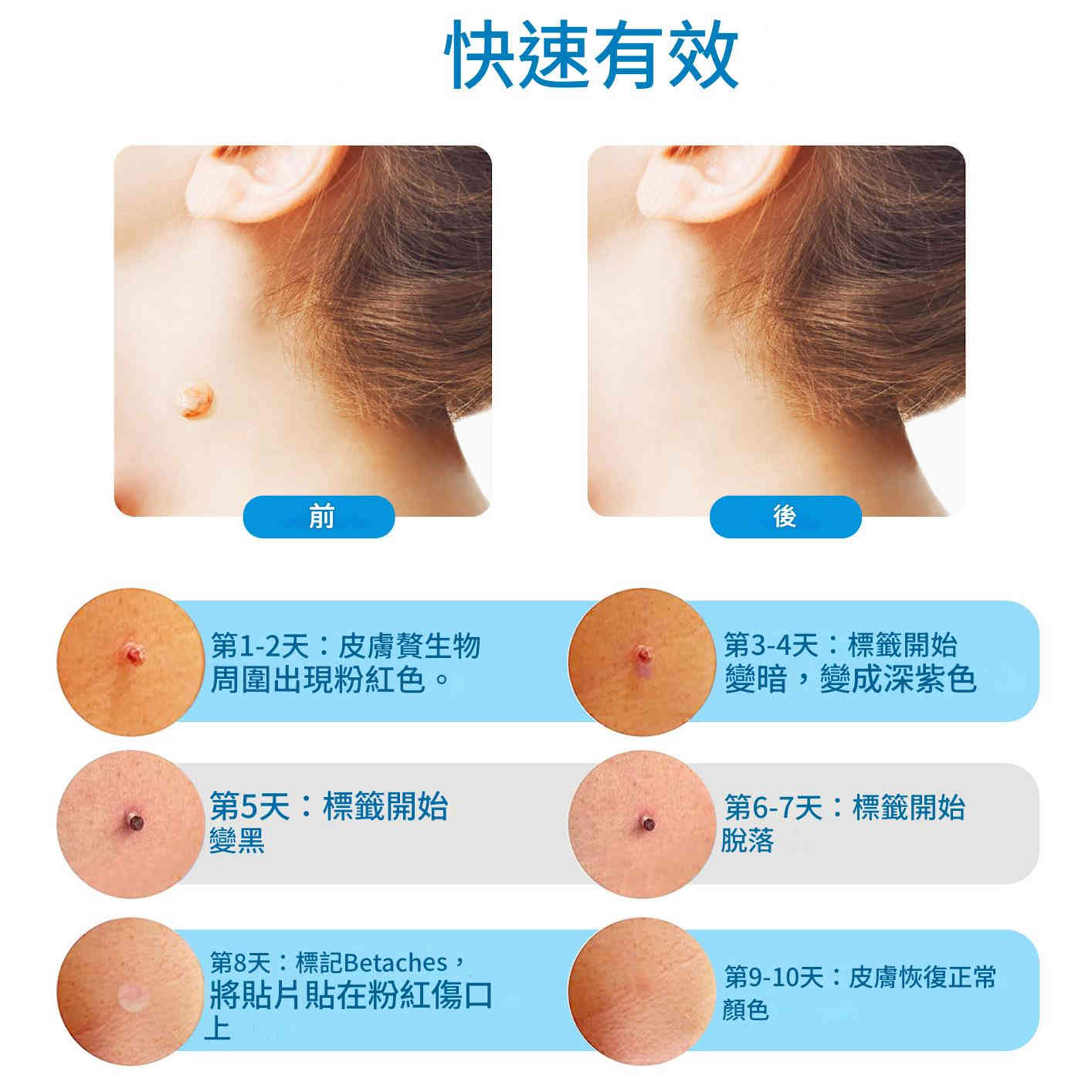 elaimei 2 合1 皮膚疣去除工具套件