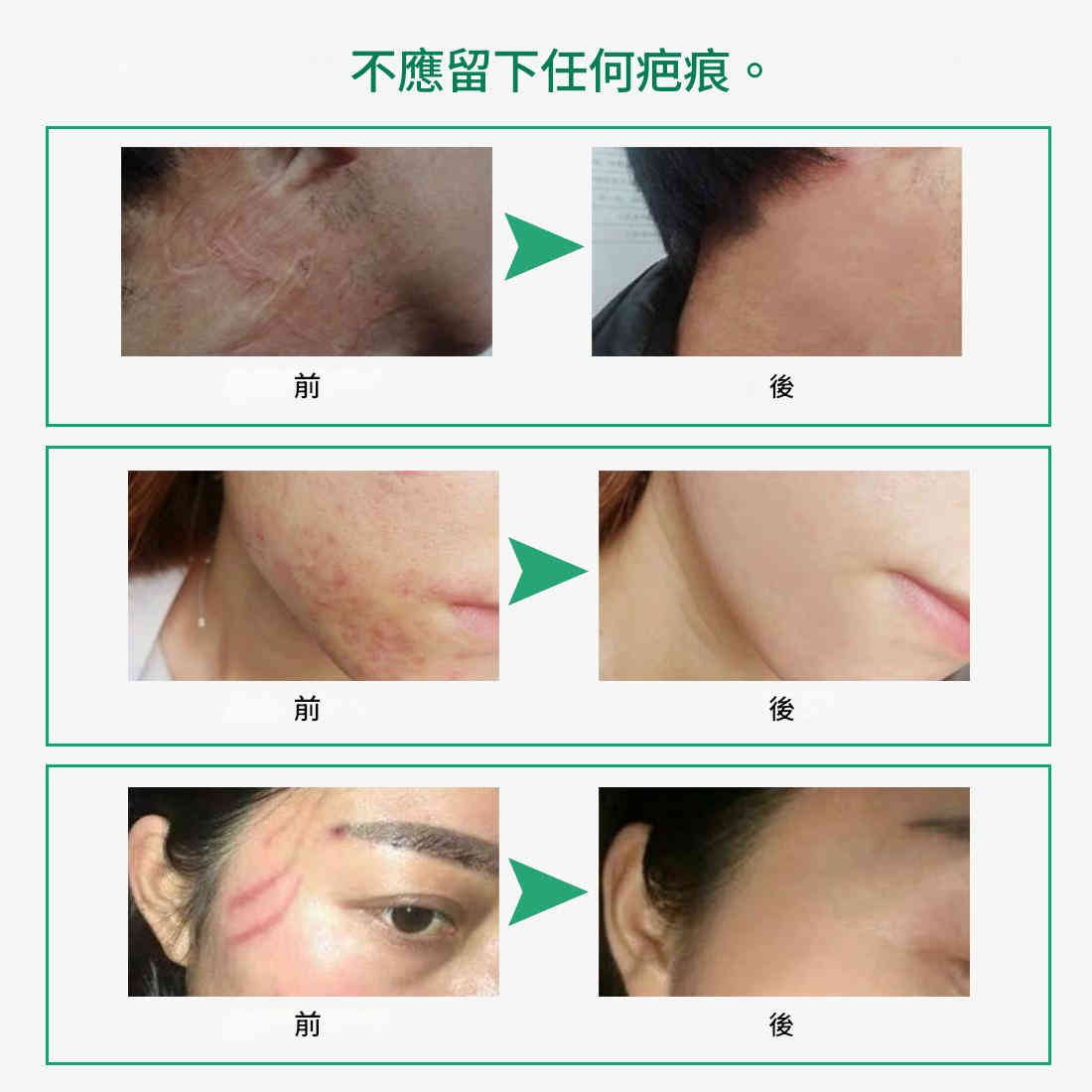 elaimei 積雪草提取物去疤痕膏50ml/盒