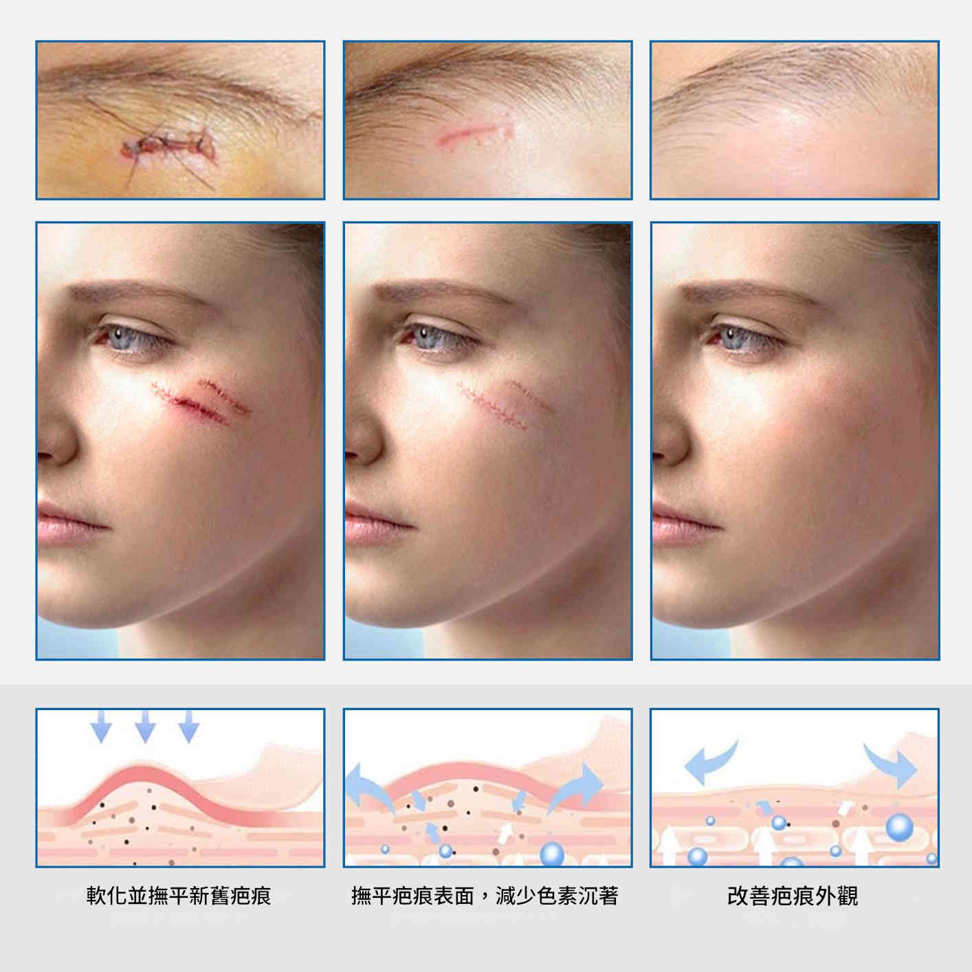 elaimei 專業醫療級透明矽膠疤痕貼x2