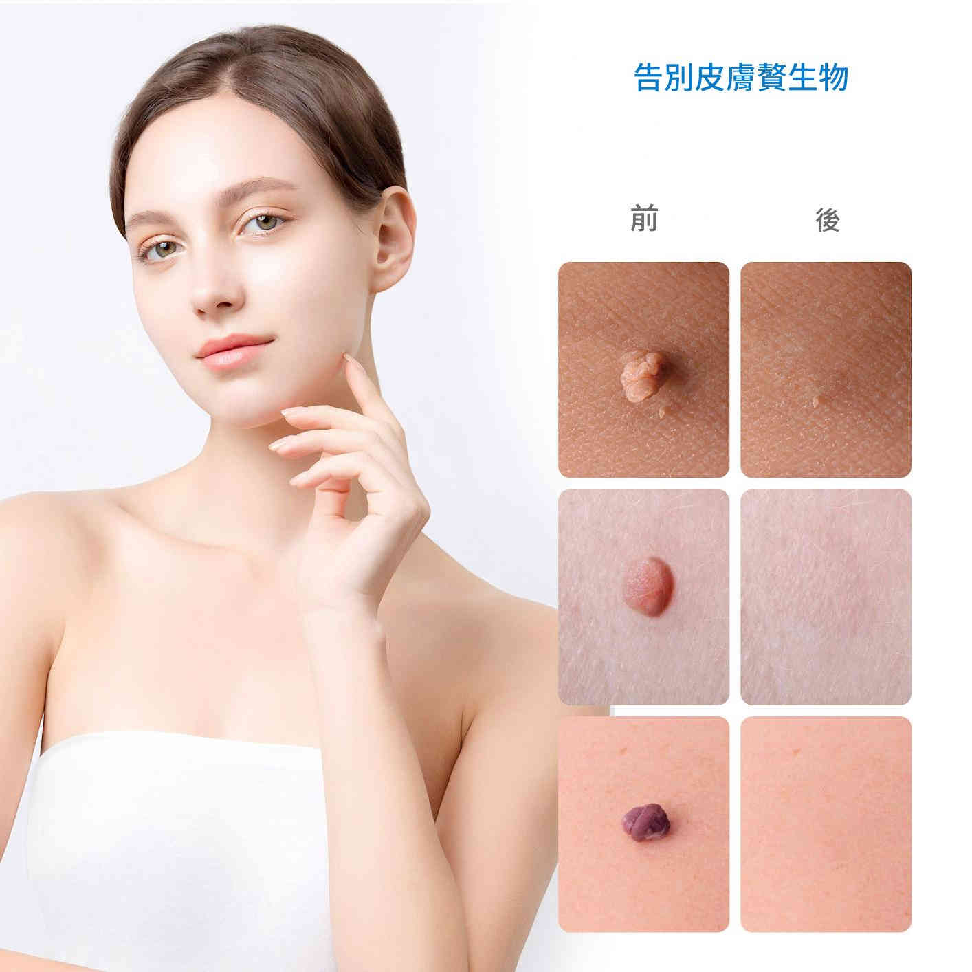 elaimei 2 合1 皮膚疣去除工具套件