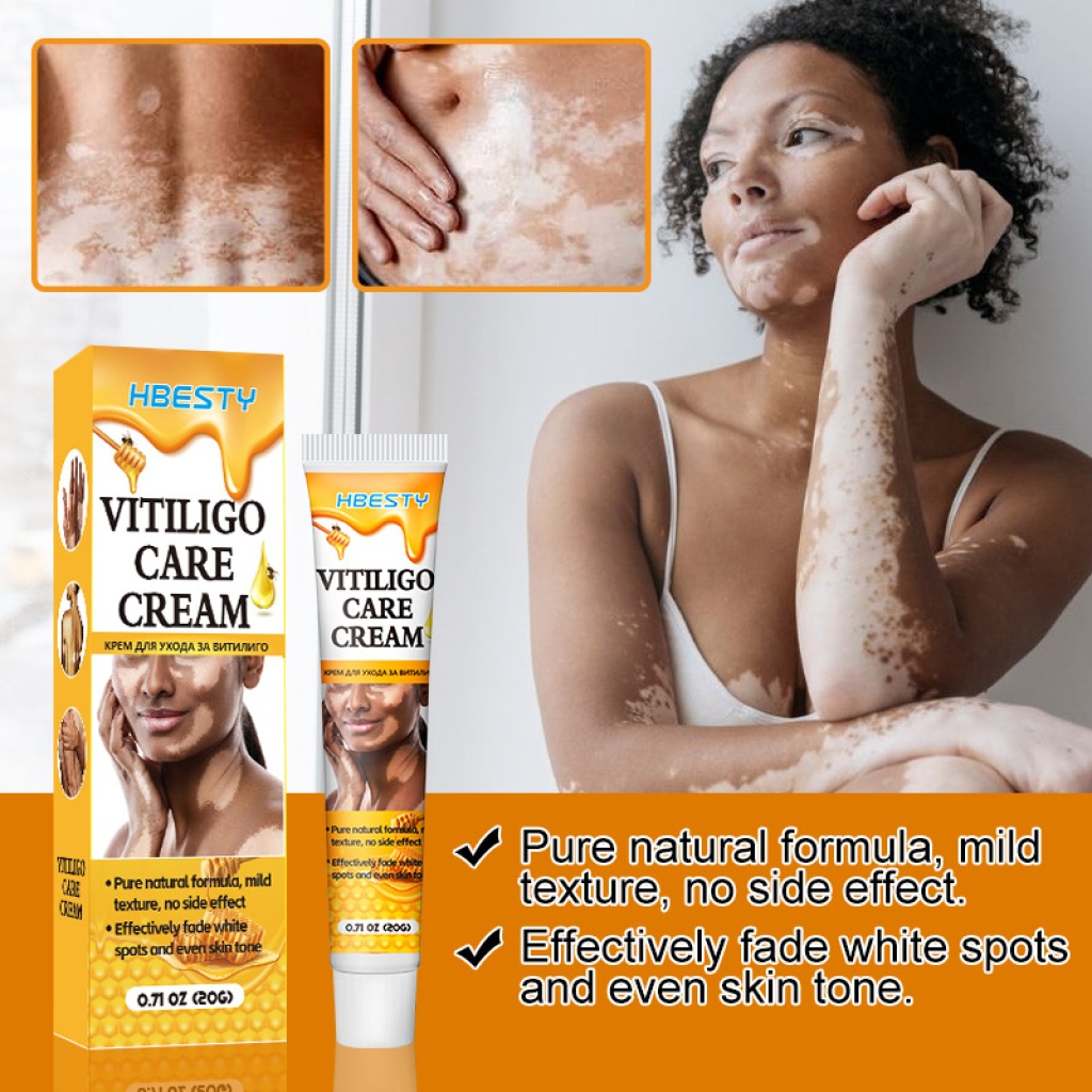 hbesty 白斑護理霜 20g/支｜純天然配方，溫和淡化白斑，重現均勻膚色