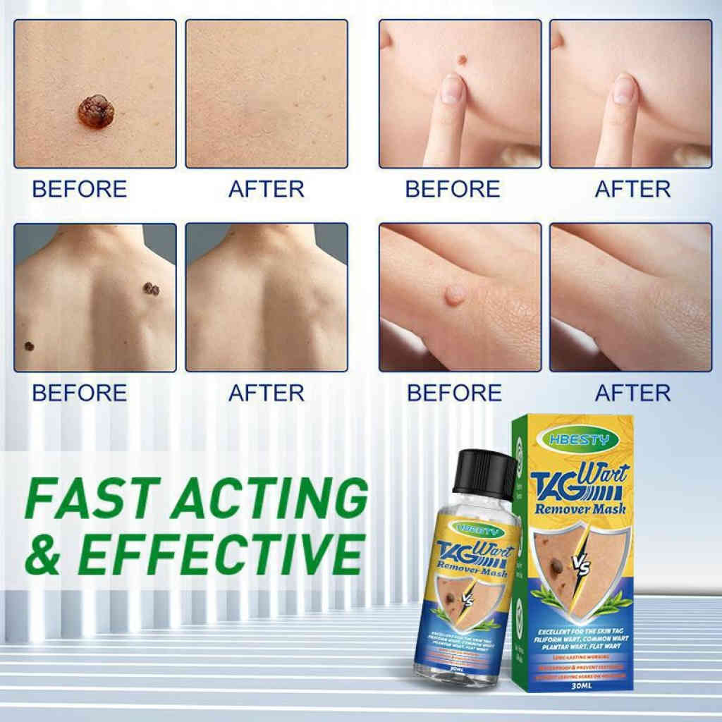 hbesty 專業去疣液 30ml/支｜快速清除皮膚贅生物，重現平滑潔淨肌膚