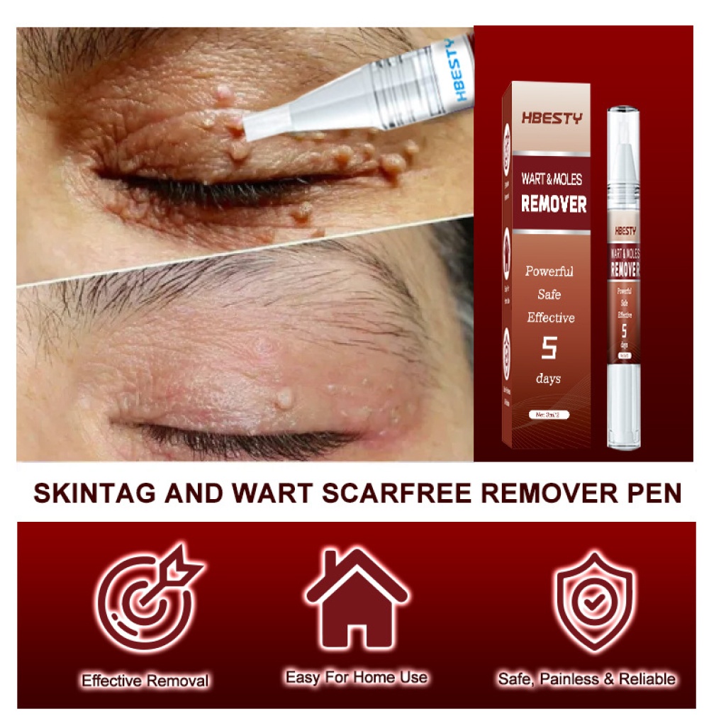 【hbesty 疣痣去除筆 3ml/支】5天見效！強效、安全、無痛，在家輕鬆去除疣、痣、肉贅