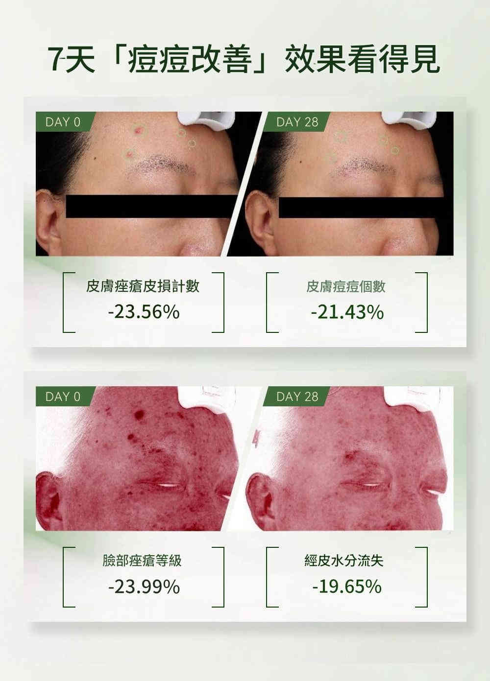 lanlatér 超分子緩釋水楊酸准去痘精華液 15ml/盒