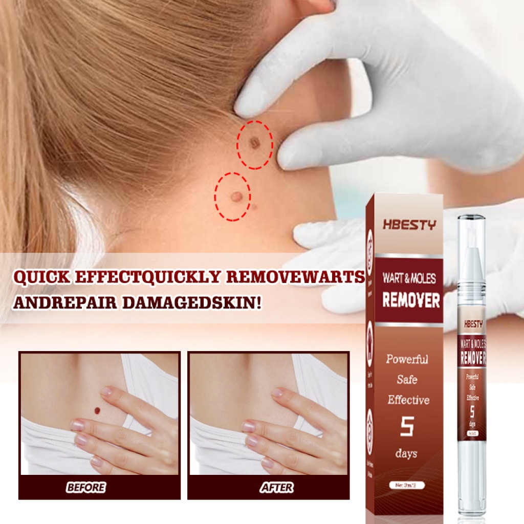 【hbesty 疣痣去除筆 3ml/支】5天見效！強效、安全、無痛，在家輕鬆去除疣、痣、肉贅
