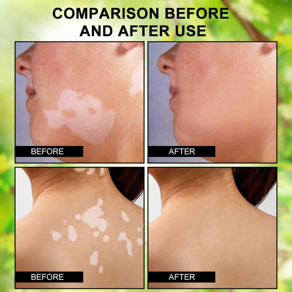 hbesty 白斑護理霜 20g/支｜純天然配方，溫和淡化白斑，重現均勻膚色