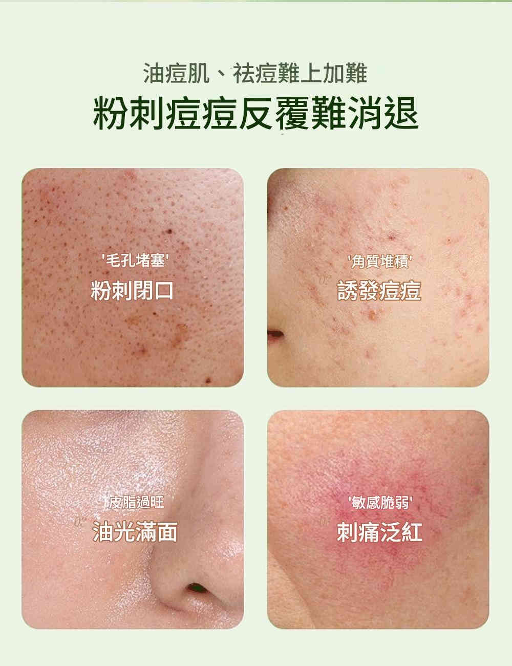 lanlatér 超分子緩釋水楊酸准去痘精華液 15ml/盒