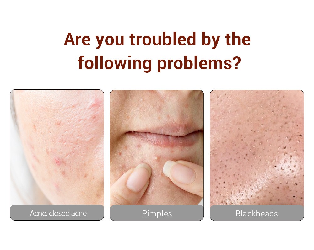 lanbena 玫瑰金刺針4件套頭