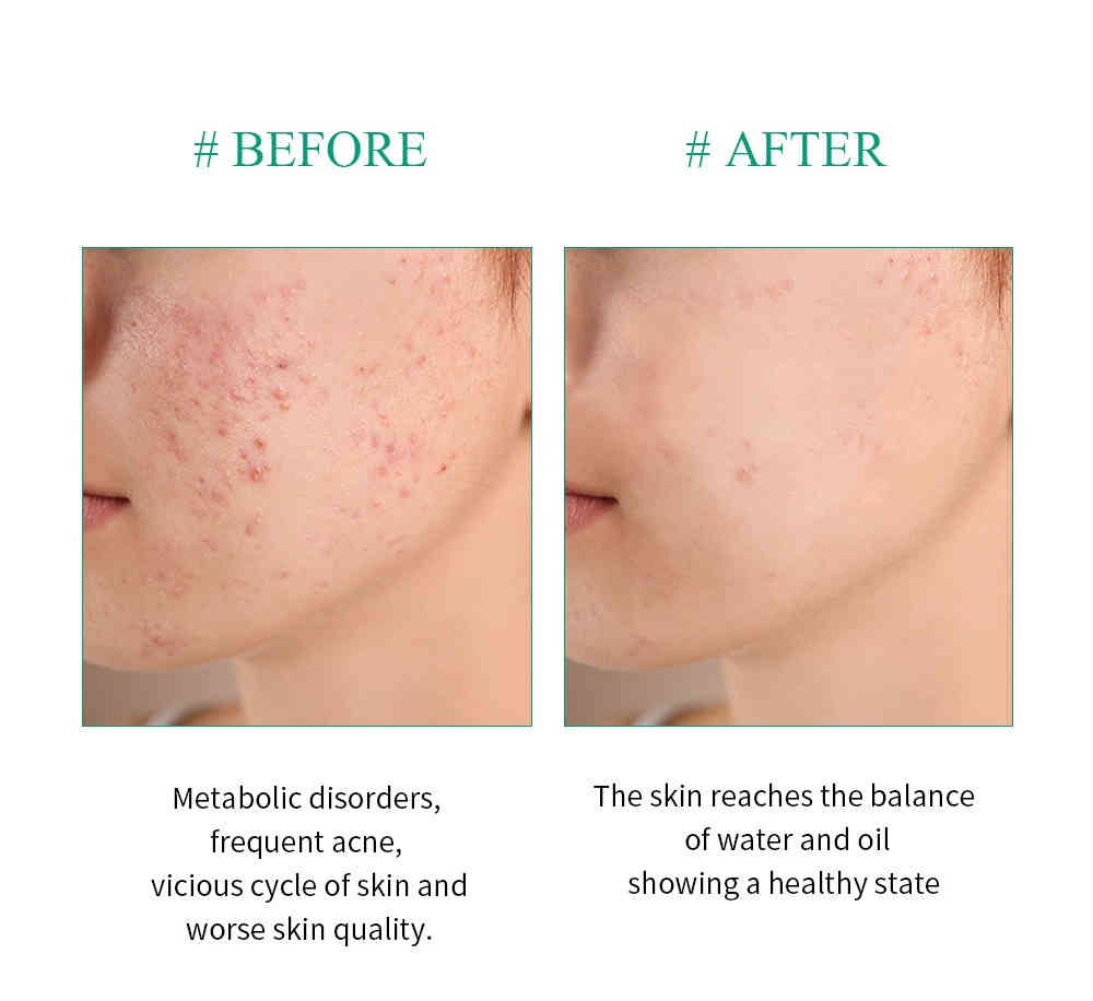 breylee 茶樹抗痘調理露 100ml/盒