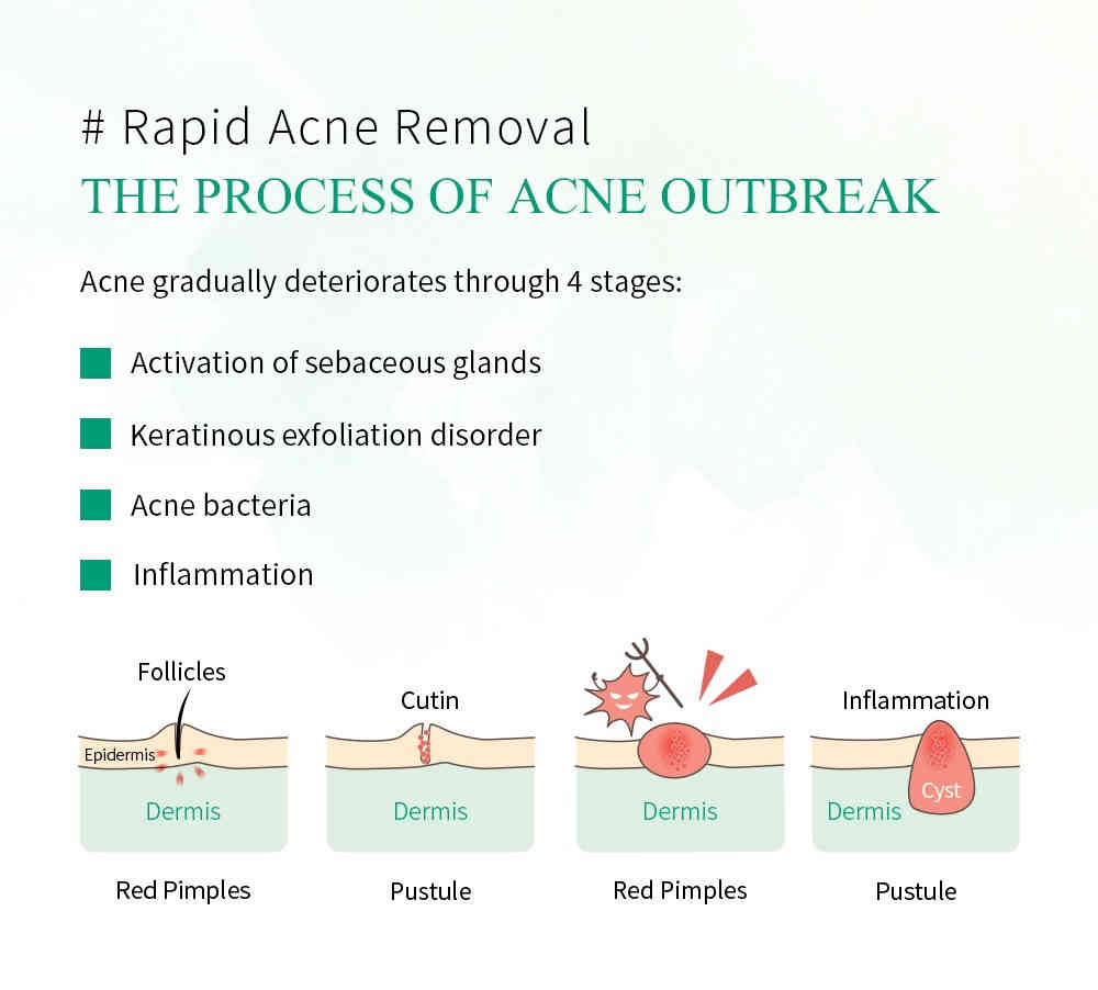 breylee 茶樹抗痘調理露 100ml/盒