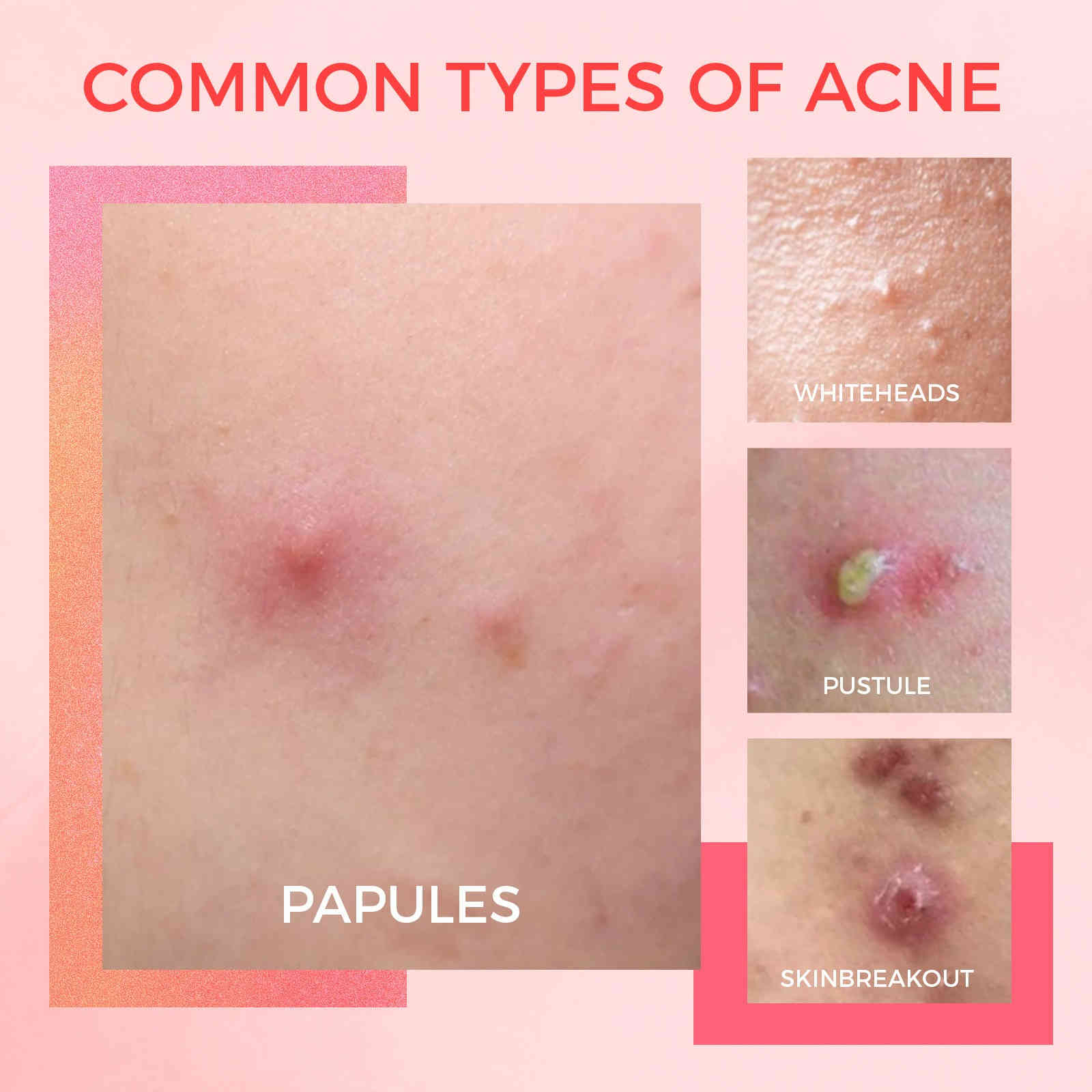 oukeya 2%水楊酸＋5%菸鹼醯胺戰痘小粉水 10ml/盒x3