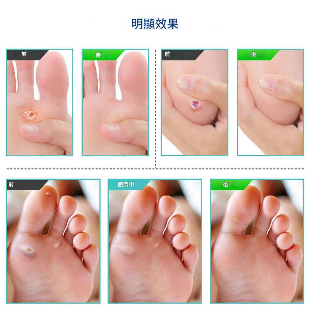 hbesty 雞眼疣去除液 30ml/盒