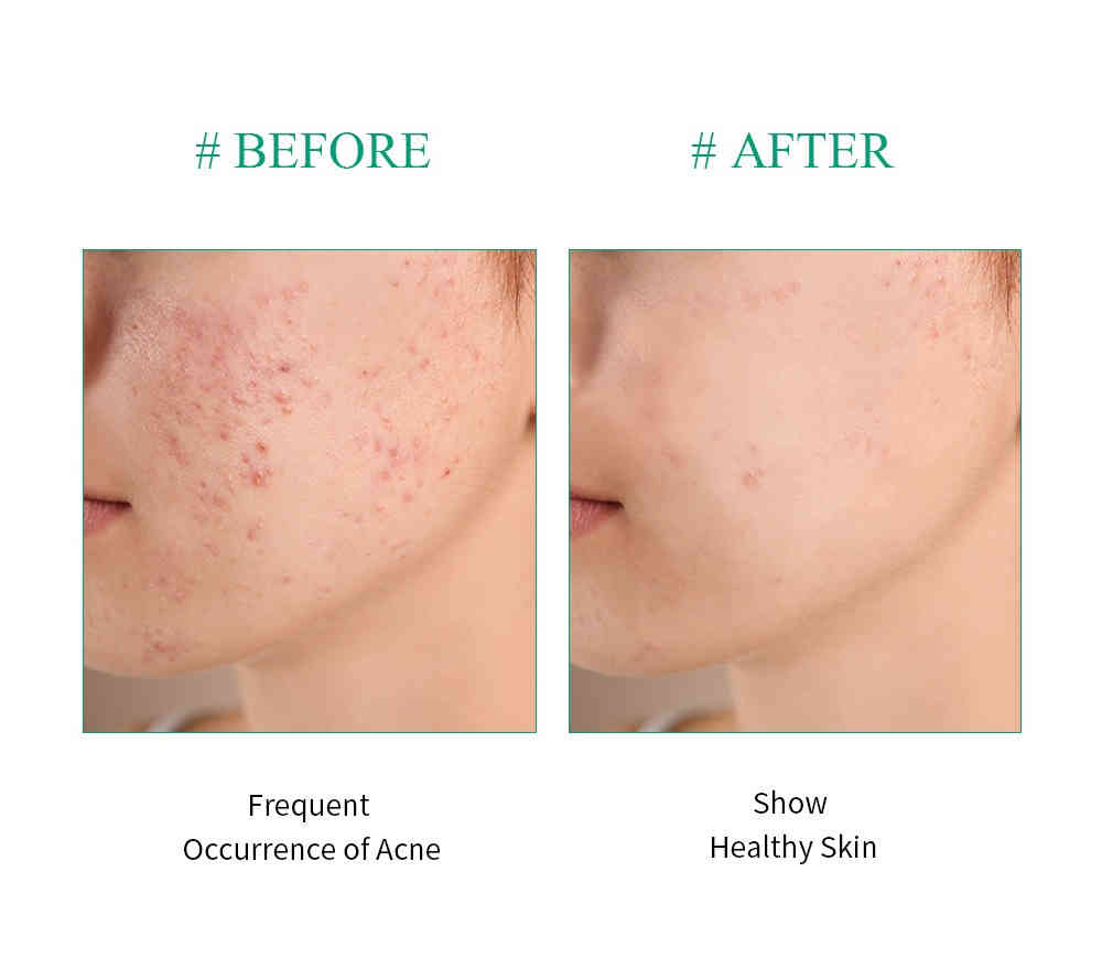 breylee 茶樹抗痘修護精華 30ml/盒