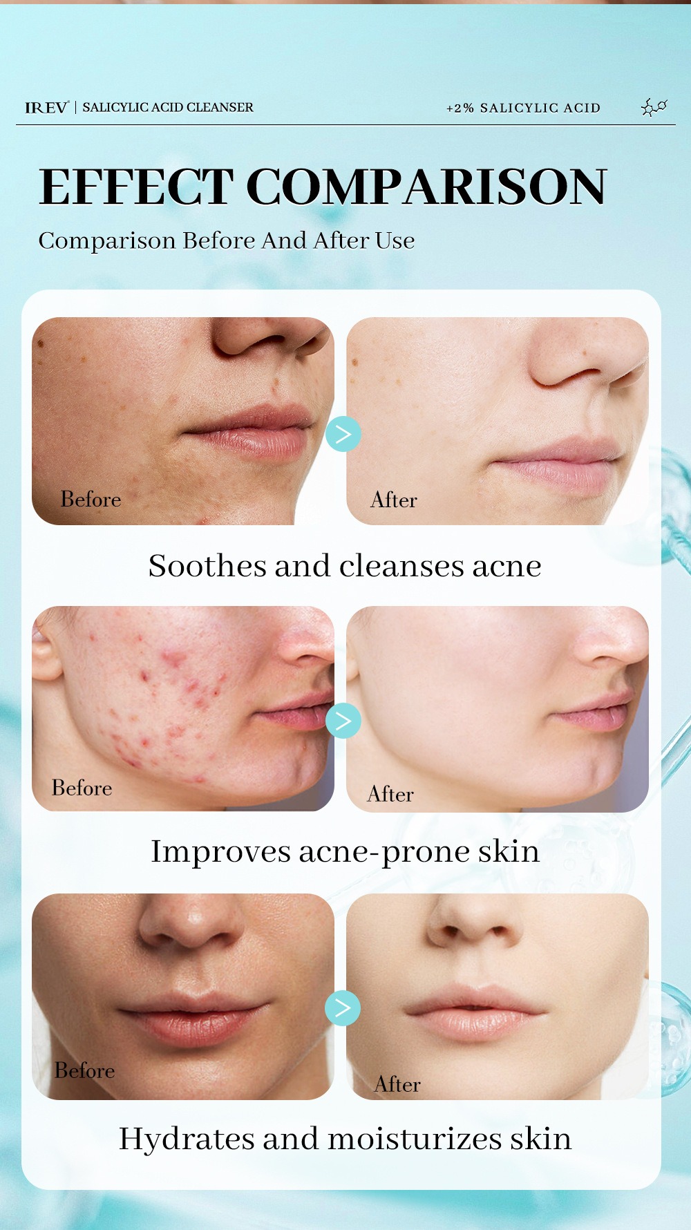 2%水楊酸水楊酸潔面乳100ml/支