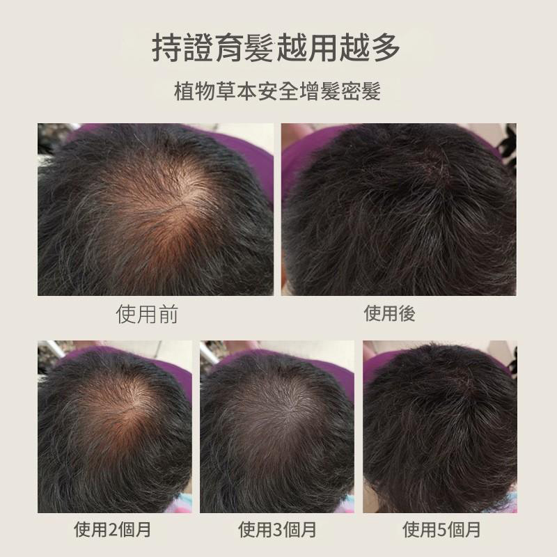 儒意防脫烏發育發液100ml